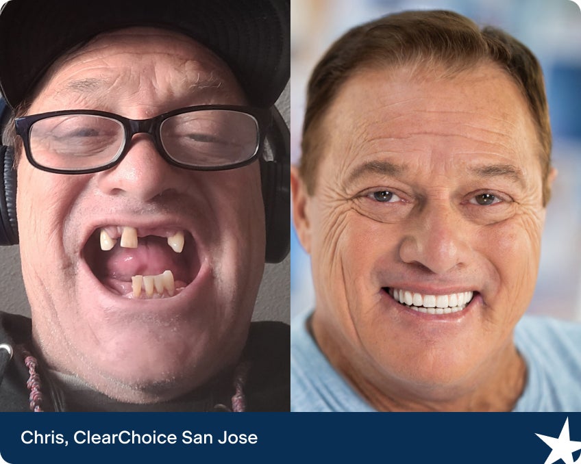 Chris de ClearChoice San José pasó de una sonrisa deteriorada a una completamente transformada con implantes dentales.