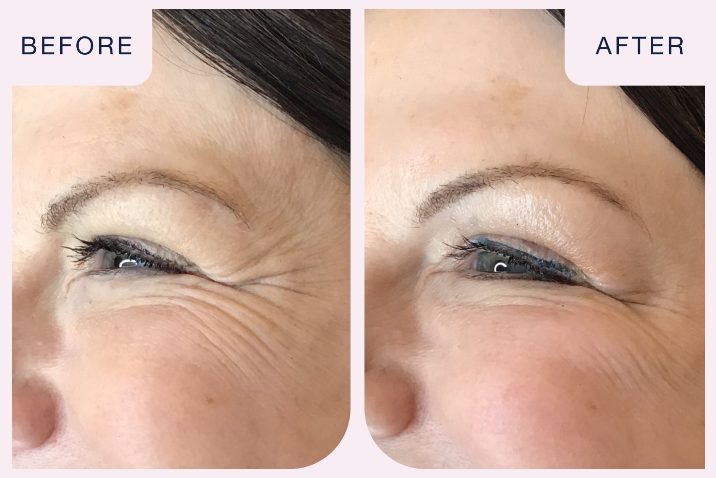 Before and after image of a botox treatment targeting crow's feet.