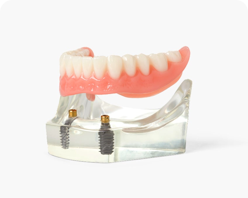 A close-up of a lower denture mounted on a clear model with two visible dental implants, used to demonstrate implant-supported dentures.