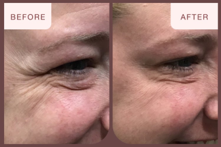 Before and after image of a botox treatment featuring fine lines and wrinkles around the eyes.