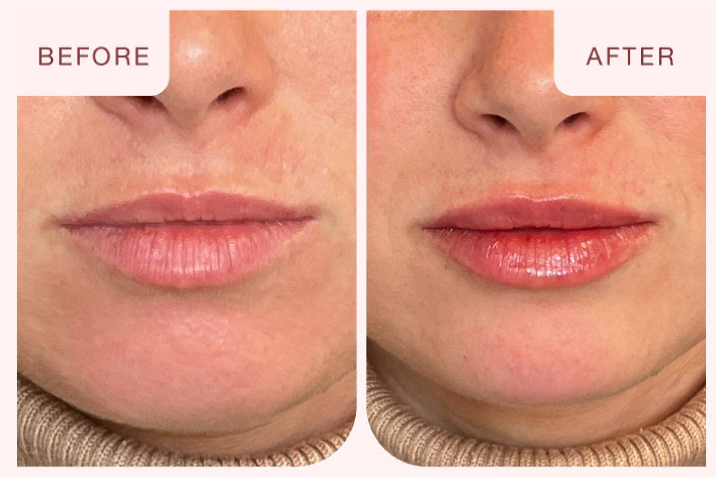 Before and after image of a lip filler treatment at Chapter Aesthetic Studio.