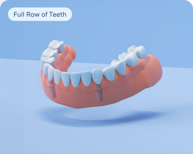 A 3D rendering of implant dentures showing a full row of teeth, representing Aspen Dental's solution for complete tooth replacement.