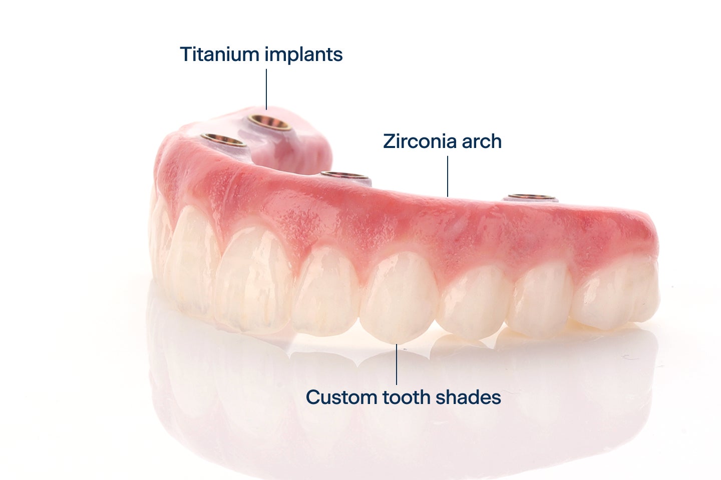 An image featuring an upper arch dental implant with titanium implants, zirconia arch, and custom tooth shades.