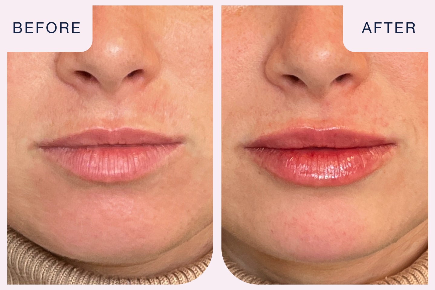 Before and after image of a lip filler treatment.