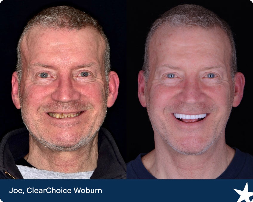 Before and after photos of Joe, a ClearChoice patient, showcasing his dental implant transformation. The images highlight the improvement in his smile and dental health.