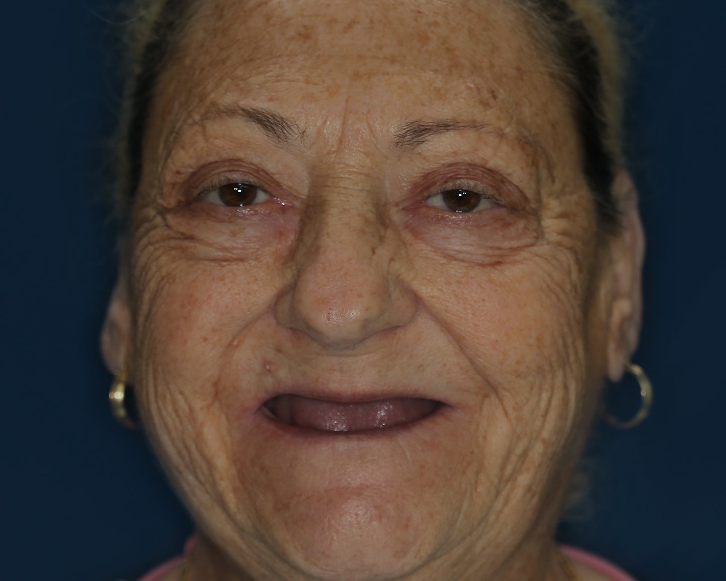 An image of Josie, a ClearChoice West Covina center patient, before her dental implants. Having lost all her teeth, Josie experiences difficulty talking, eating, and smiling confidently.