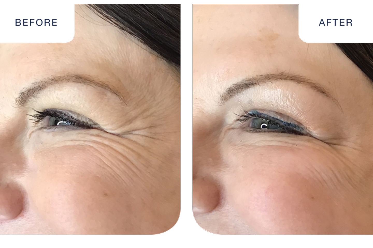 A patent shows a before and after image after getting Botox