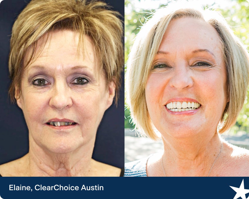 Before and after photos of Elaine, showcasing her dental implant transformation at ClearChoice. The images highlight the improvement in her smile and dental aesthetics.