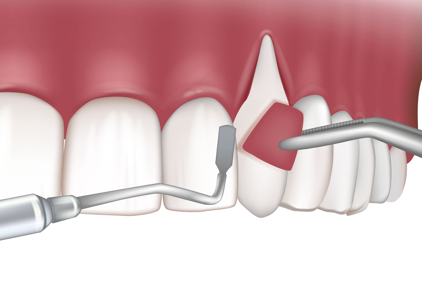 3D illustration of a gum flap surgery procedure, where a section of the gum is lifted to access and clean deep plaque and tartar buildup. This periodontal treatment helps restore gum health and prevent tooth loss. Aspen Dental provides expert surgical solutions for advanced gum disease.