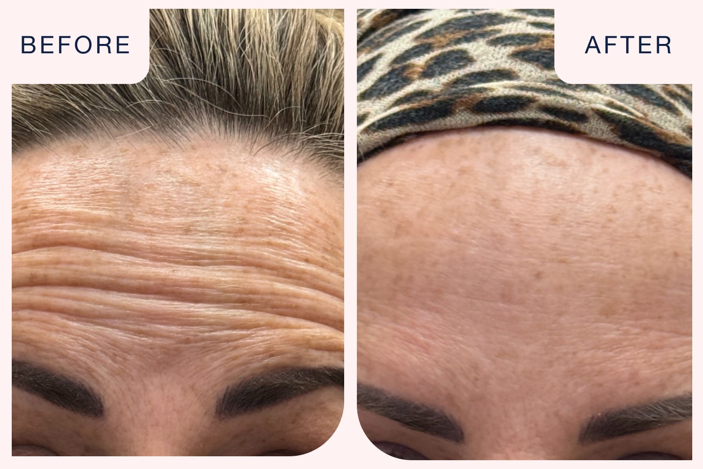 Before and after image of a botox treatment targeting forehead fine lines and wrinkles.