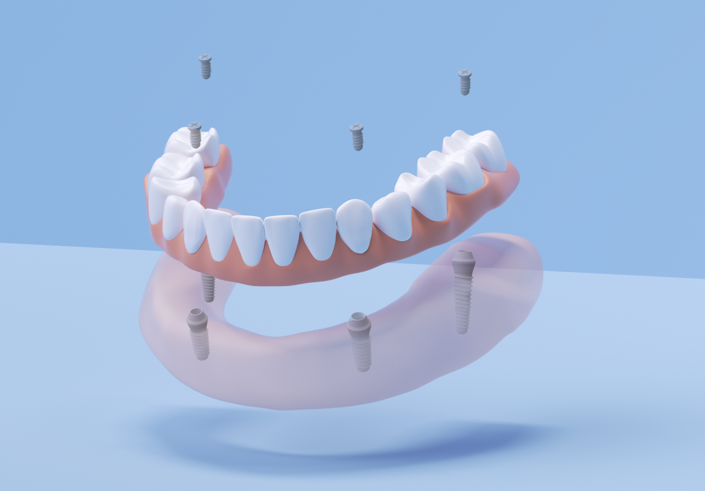 Aspen Dental All on 4 dental implants. 