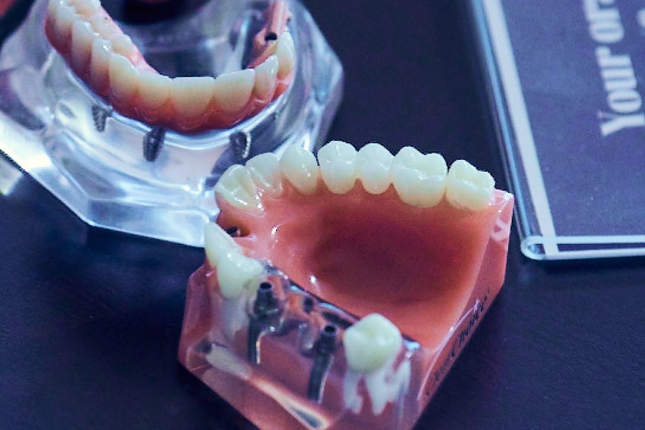 Close-up of a dental implant model showcasing realistic artificial teeth and implant placements on a dark background. A ClearChoice branding element emphasizes affordability and quality care.