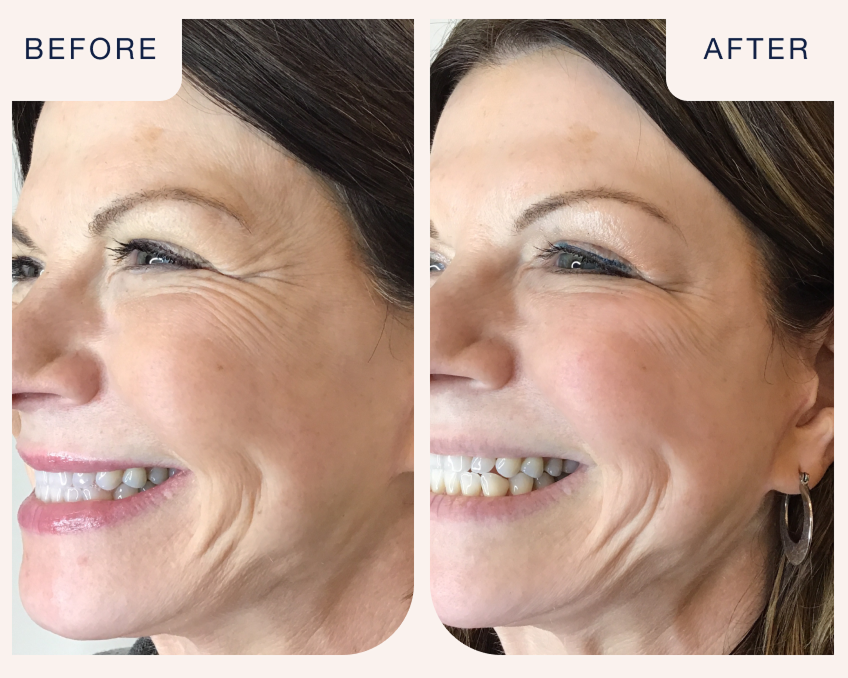  Xeomin before and after comparison showing a woman’s crow’s feet eye area, highlighting treatment results at Chapter. Text on image reads “Before and After.”