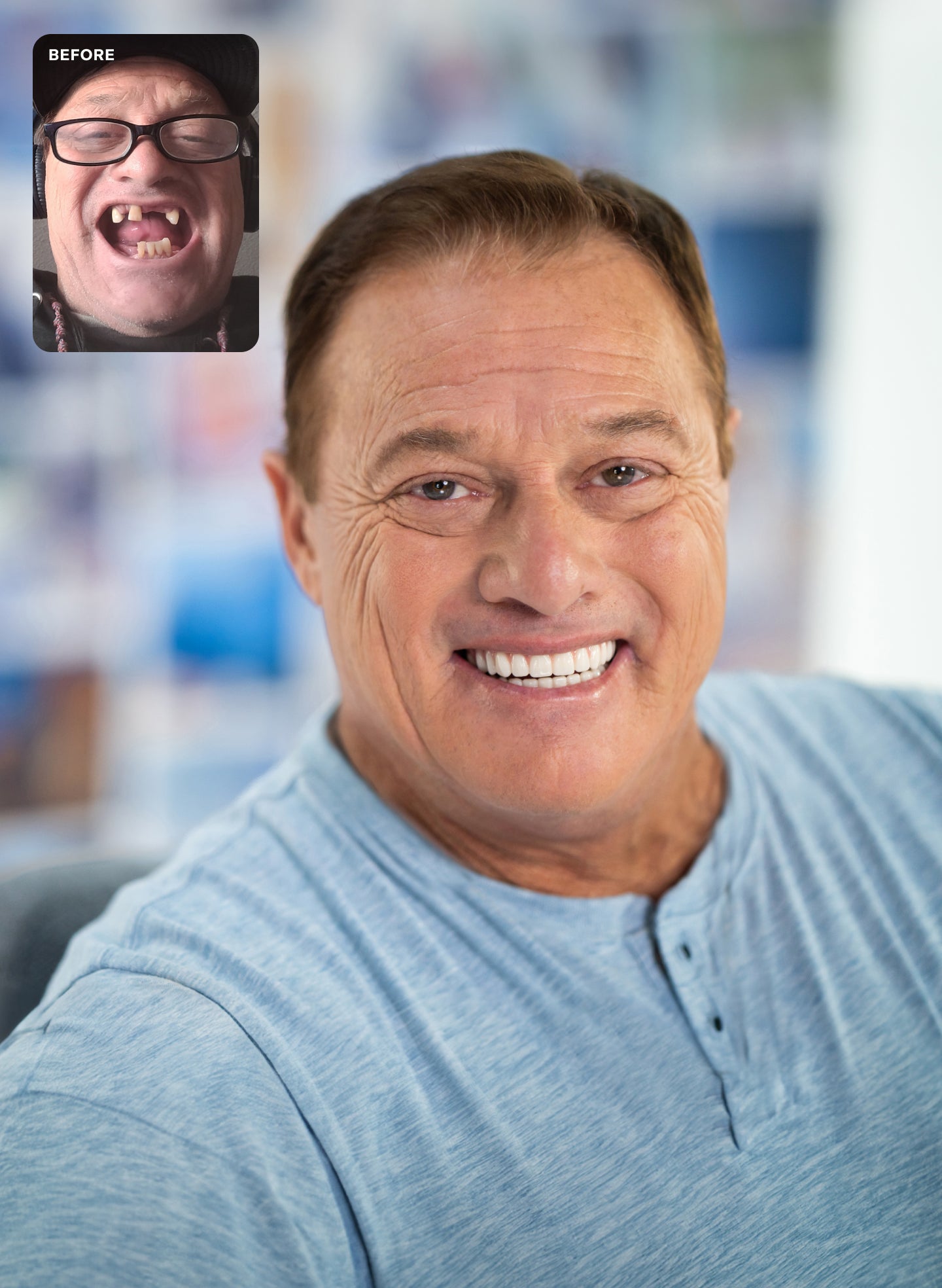 Before and after photo comparison of Eric from San Jose, showcasing dramatic smile transformation with ClearChoice dental implants.