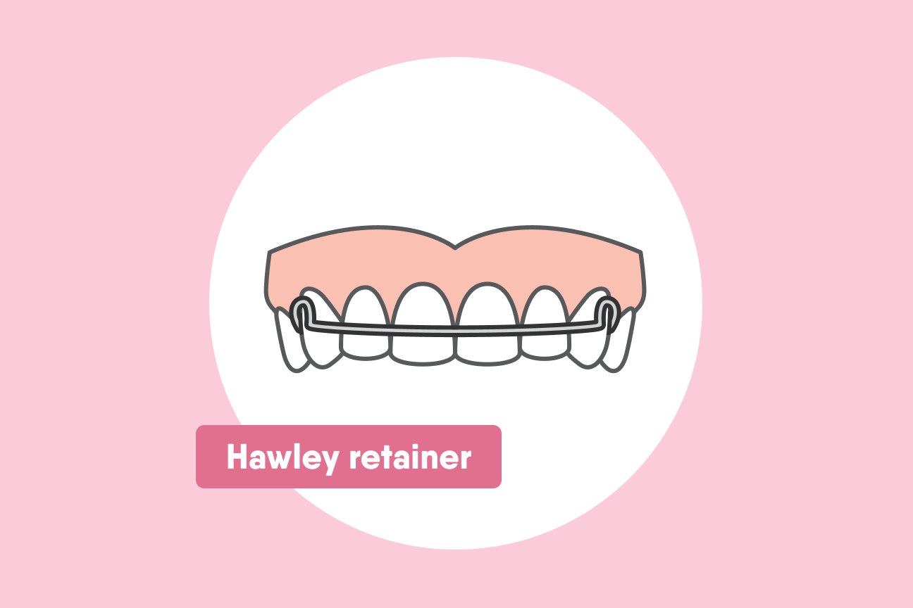 Illustration of Motto Hawley retainer with a wire structure fitting over the front teeth and an acrylic base for support, displayed on a pink background.