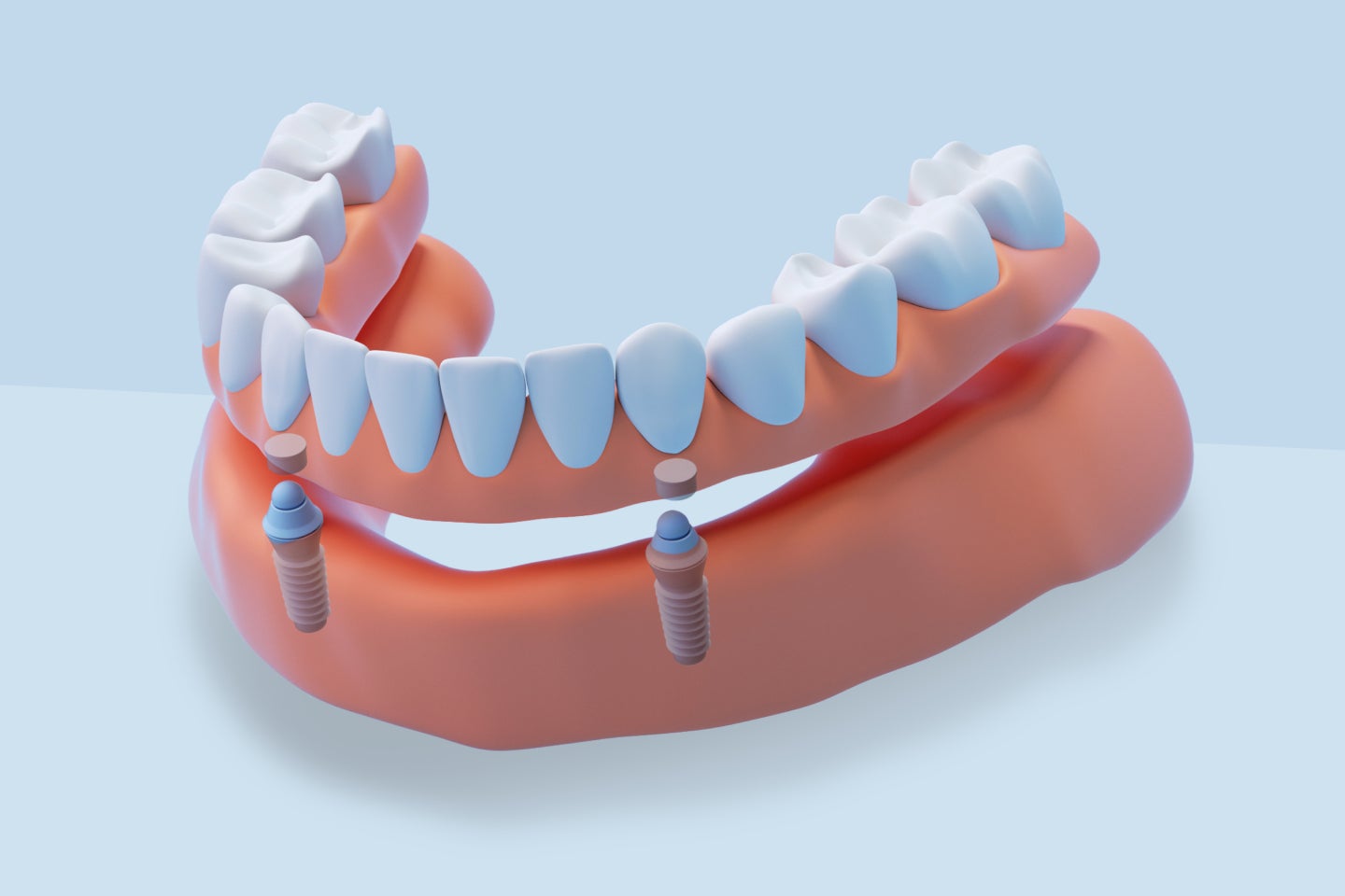 A 3D illustration of dental implant-supported dentures, featuring two implants securing a lower denture for stability. The image highlights ClearChoice’s advanced implant solutions for restoring smiles.