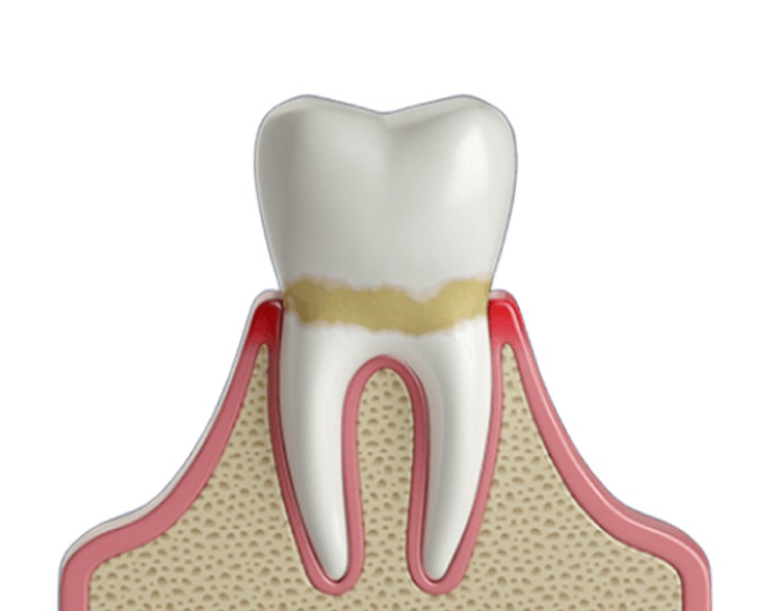 3D illustration of a tooth with plaque buildup along the gumline, showing early signs of gum disease. The gum tissue appears inflamed, indicating potential gingivitis. Aspen Dental provides expert care and solutions for treating and preventing gum disease.