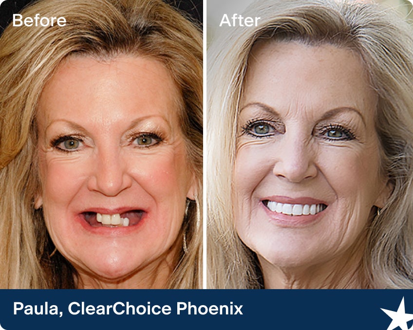 Transformation of Paula’s smile in before and after shots, revealing straighter, whiter teeth; demonstrates what dental implants are and how they can rejuvenate facial aesthetics.