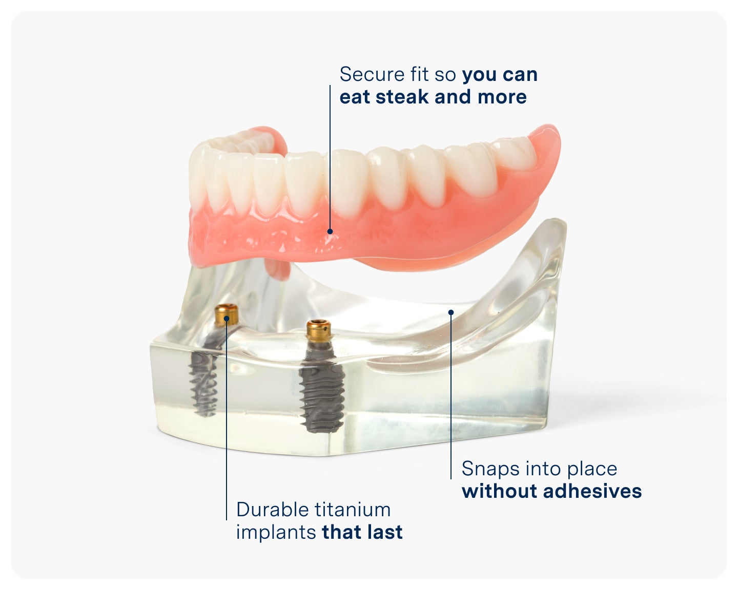 Demonstration model of implant-supported dentures showing secure titanium implants and snap-in fit, offering stability and adhesive-free functionality at Aspen Dental.