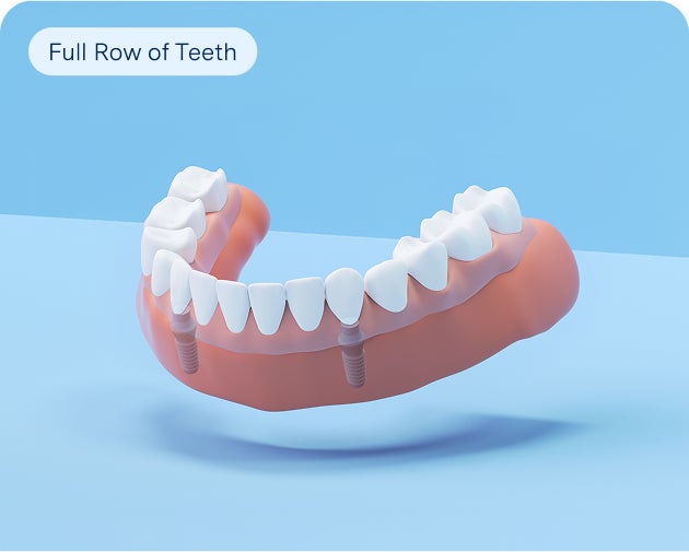 An implant denture that forms a full row of teeth is shown on a blue background