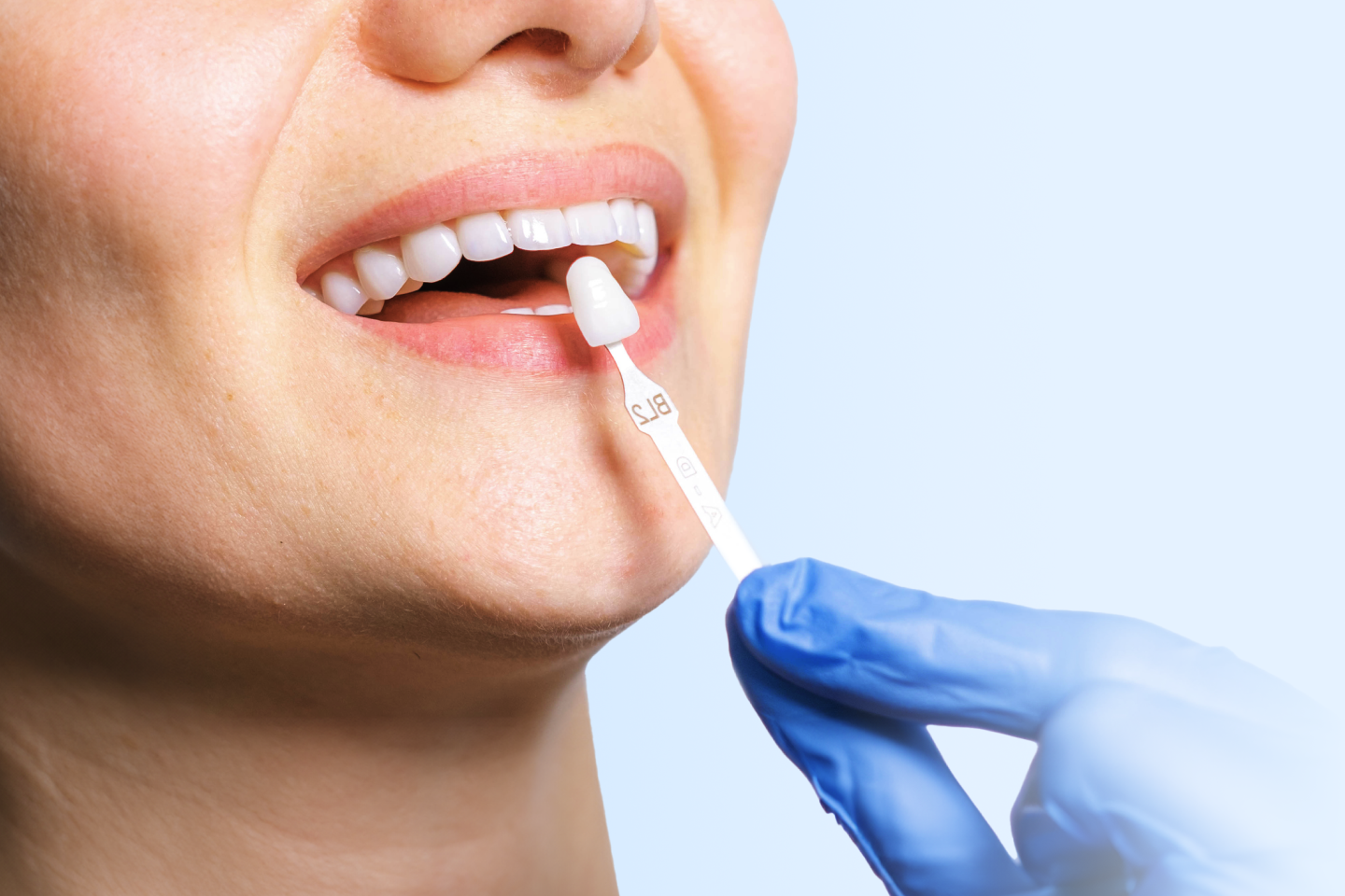 Composite Veneers Cost, Benefits, and Longevity Aspen Dental