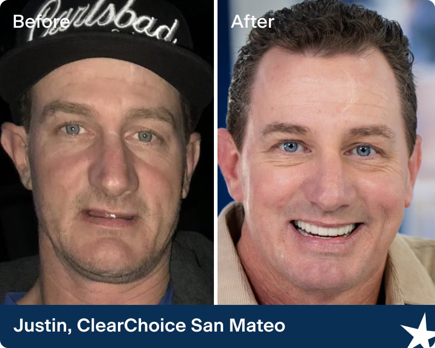 A before and after photo of Justin, a ClearChoice patient from the San Mateo center, after restoring his smile with dental implants.