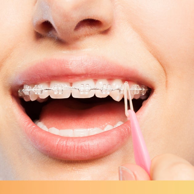 Close-up of a person cleaning their braces with a dental tool, revealing straight white teeth.
