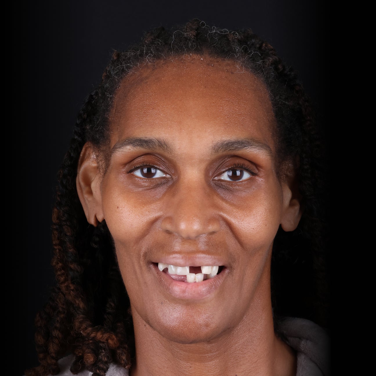 Before photo of a ClearChoice Grand Rapids patient showing significant dental issues with missing and misaligned teeth.