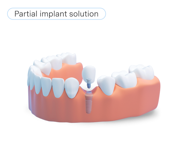  A model of an implant-supported crown, illustrating a single-tooth replacement anchored by a dental implant. The image emphasizes durability and a natural appearance.