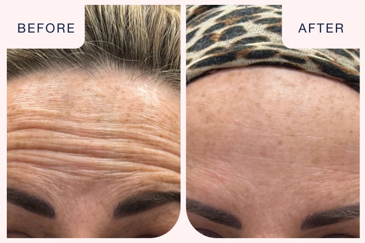 Before and after image of a botox treatment targeting forehead fine lines and wrinkles.