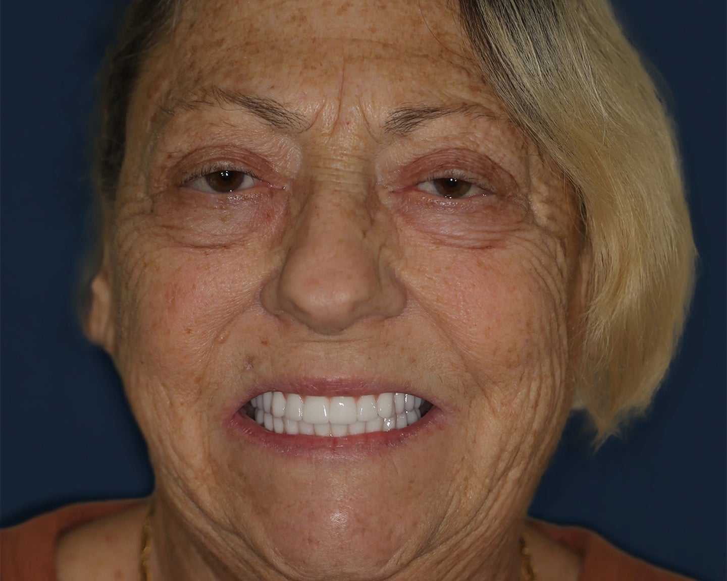 An image of Josie after receiving her full-mouth dental implants. She can now enjoy her favorite food and activities again, knowing her implants are backed for a lifetime with ClearChoice's zirconia lifetime warranty.
