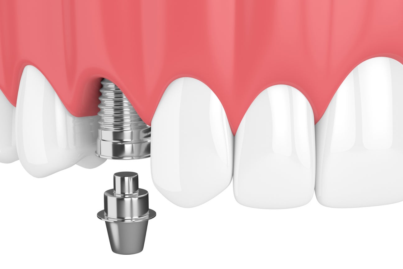 Detailed 3D diagram of a front tooth implant showing the implant, abutment, and crown placement within the gum line, illustrating advanced dental solutions by Aspen Dental.
