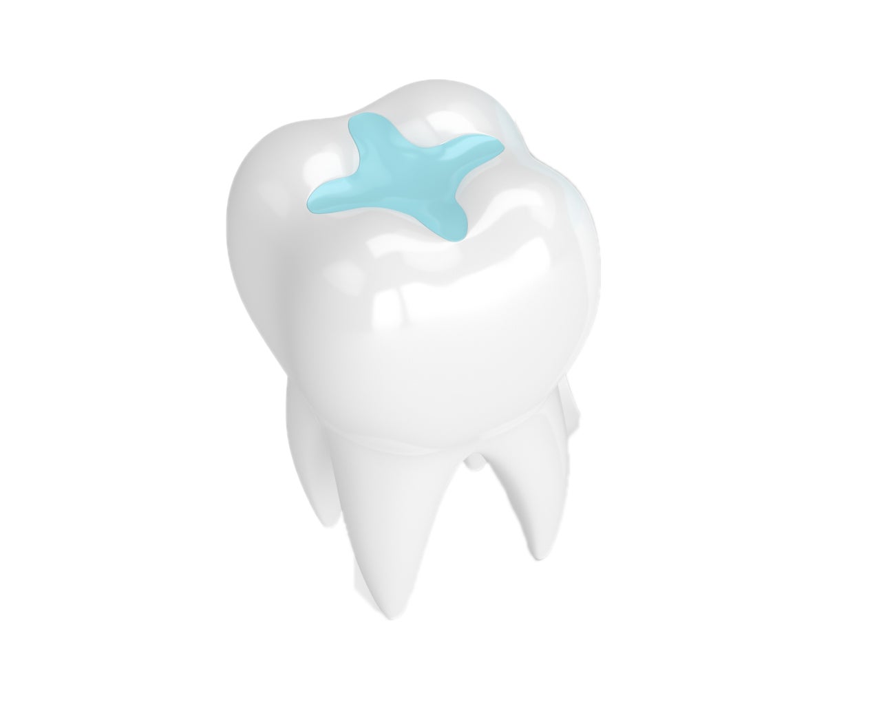A 3D model of a tooth featuring a glass ionomer filling, demonstrating a dental restoration technique used by Aspen Dental.