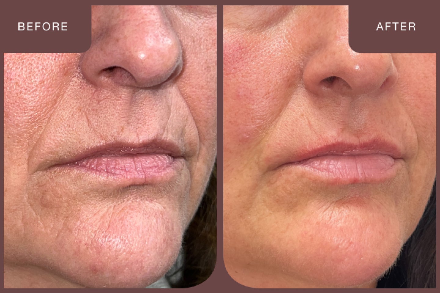 Before and after images of a guest who had a VirtueRF treatment.