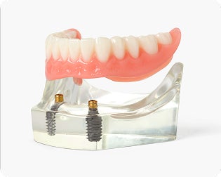 A model of a denture with two dental implants