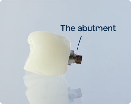An image of a implant tooth with an abutment, the part that connects the implant and the teeth.