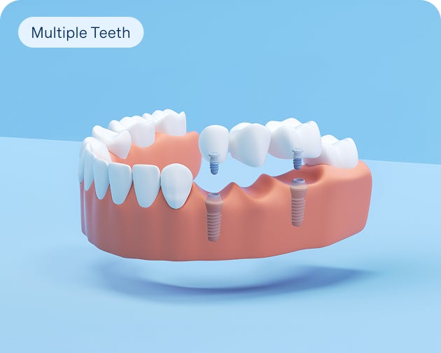 A 3D rendering of an implant-supported dental bridge restoring multiple missing teeth at Aspen Dental.