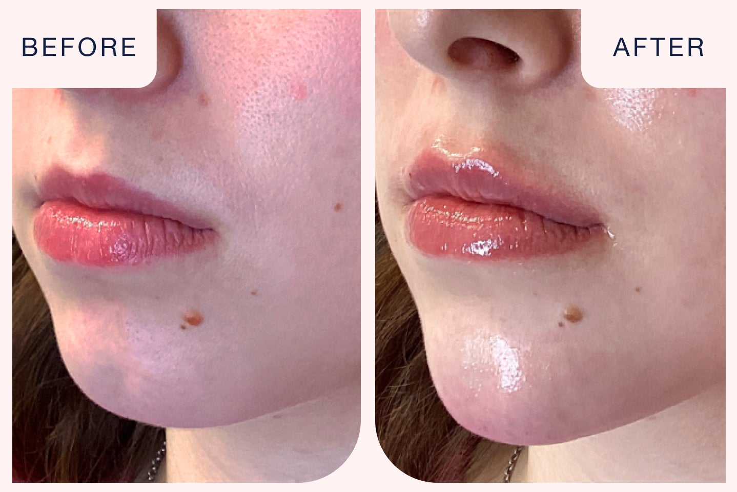 Before and after image of a dermal filler treatment targeting the chin.