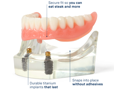 Aspen Dental implant-supported dentures model featuring durable titanium implants for a secure, adhesive-free fit, designed to enhance chewing ability and provide long-lasting comfort.