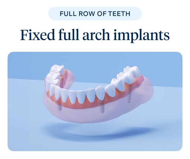 A 3D illustration of fixed full arch implants showing a complete set of teeth, symbolizing Aspen Dental's full mouth restoration solutions.