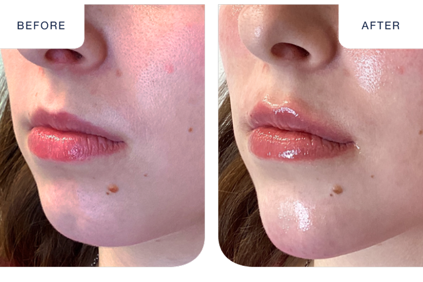A side by side comparison that shows a closeup of someone's lips before and after receiving filler treatment