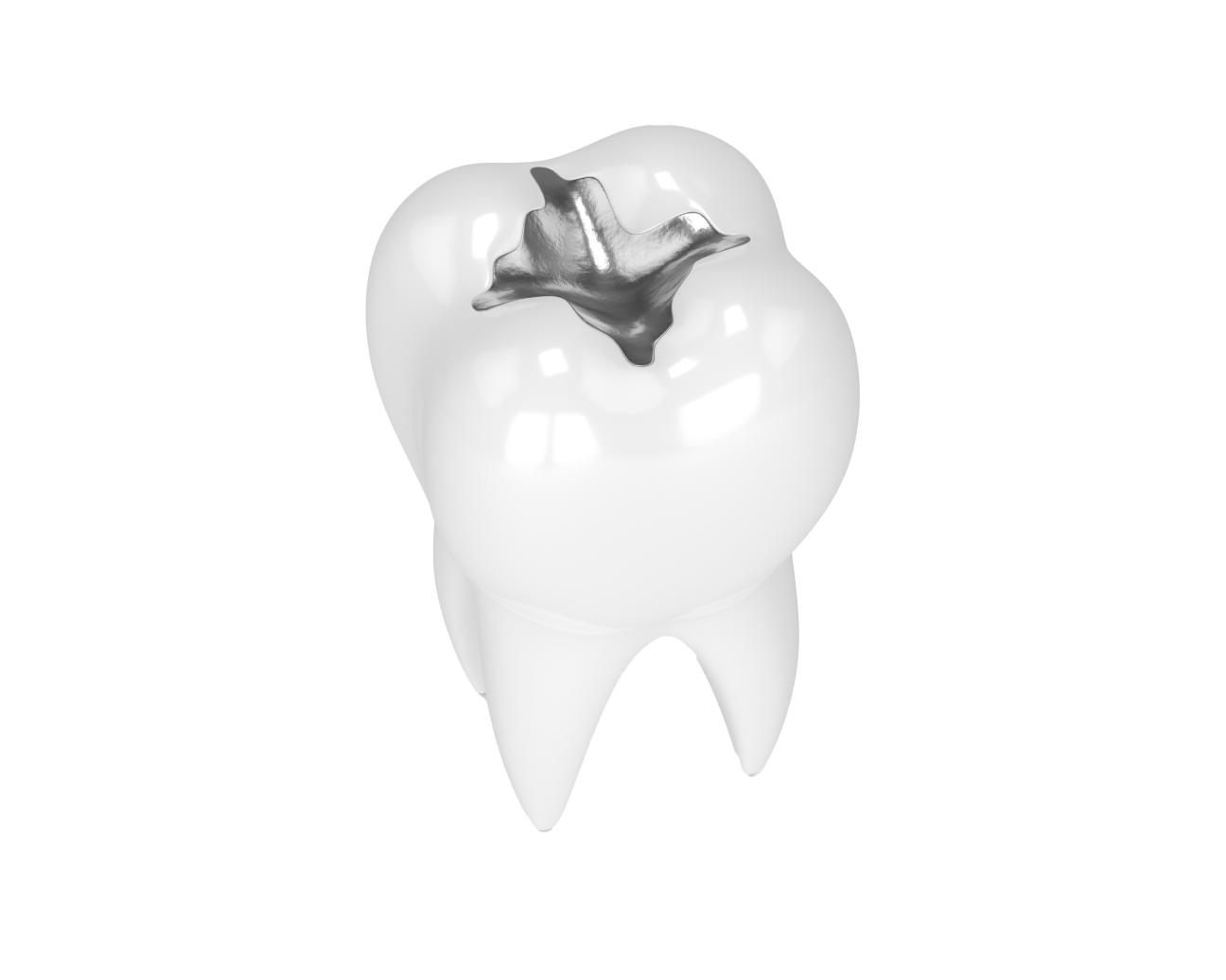 A detailed illustration of a tooth with an amalgam filling, showcasing a traditional dental restoration procedure by Aspen Dental.