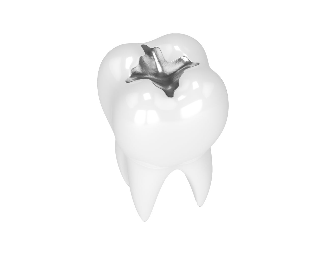 A detailed illustration of a tooth with an amalgam filling, showcasing a traditional dental restoration procedure by Aspen Dental.