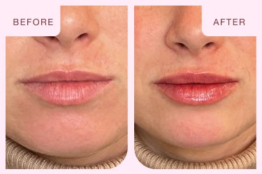 Before and after image of a lip filler treatment at Chapter Aesthetic Studio.