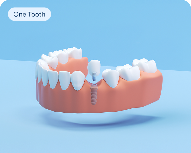 A 3D illustration of a single tooth implant replacing one tooth in the lower jaw, highlighting Aspen Dental's single tooth replacement option.