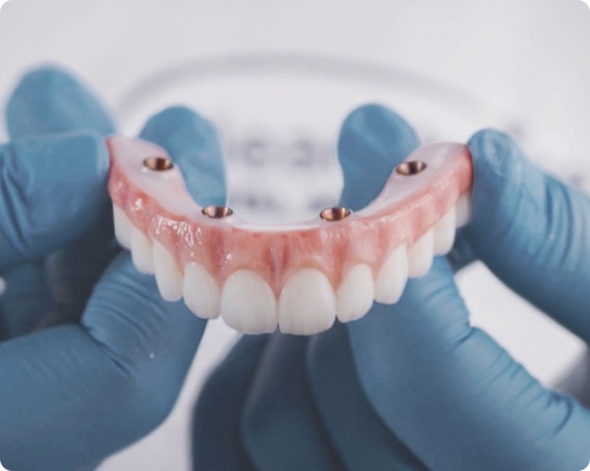 An image of an upper arch dental implant model, built to last with our highest quality zirconia arches.