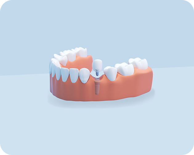 3D illustration of a single dental implant with a realistic tooth replacement provided by ClearChoice.