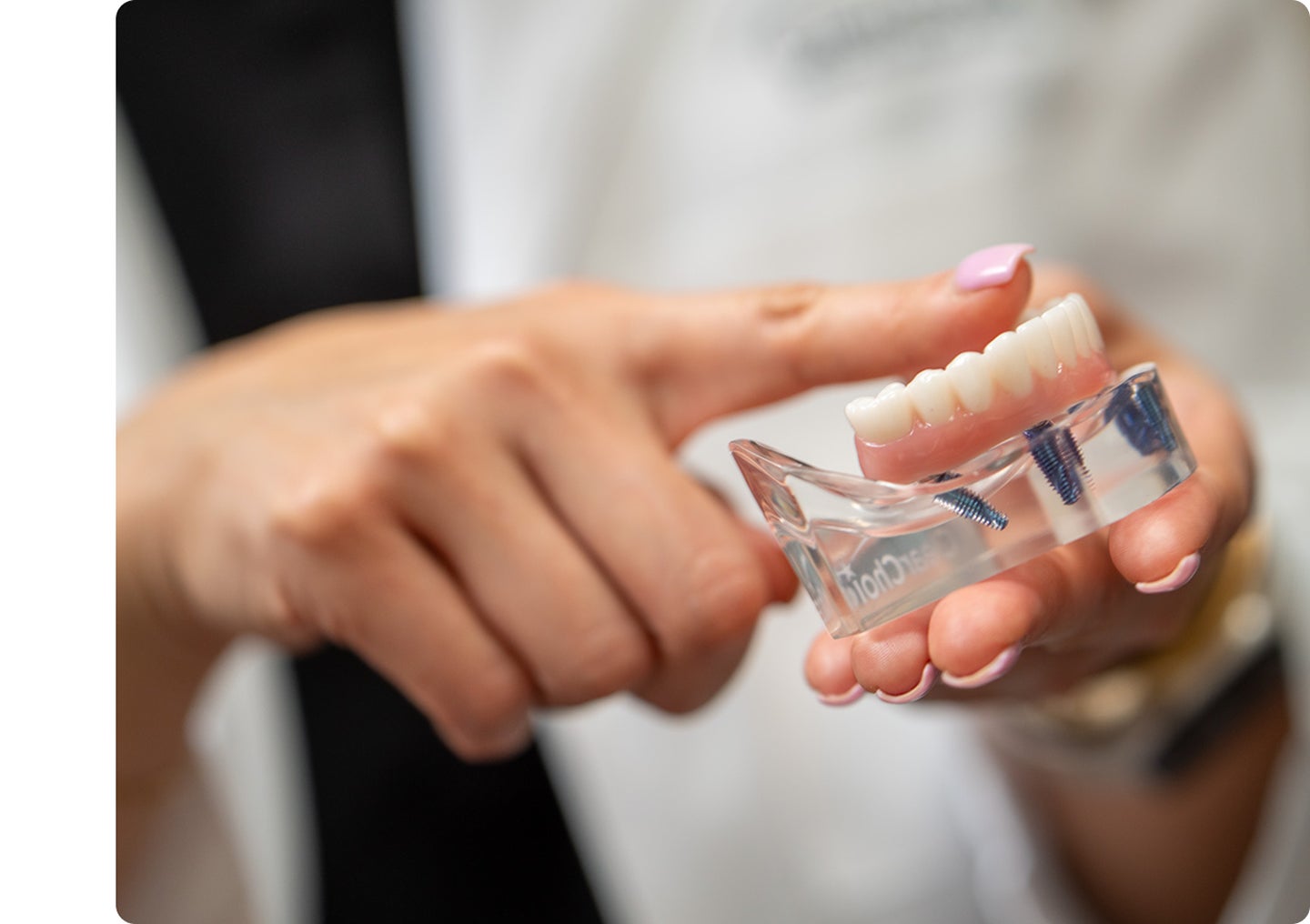 A ClearChoice doctor holding a model of lower arch dental implants.