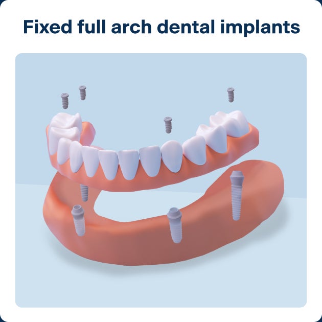 3D illustration of a fixed full arch dental implant showing a full set of upper teeth anchored by four implants; visual supports understanding of cost of dental implants and options for full mouth restoration.