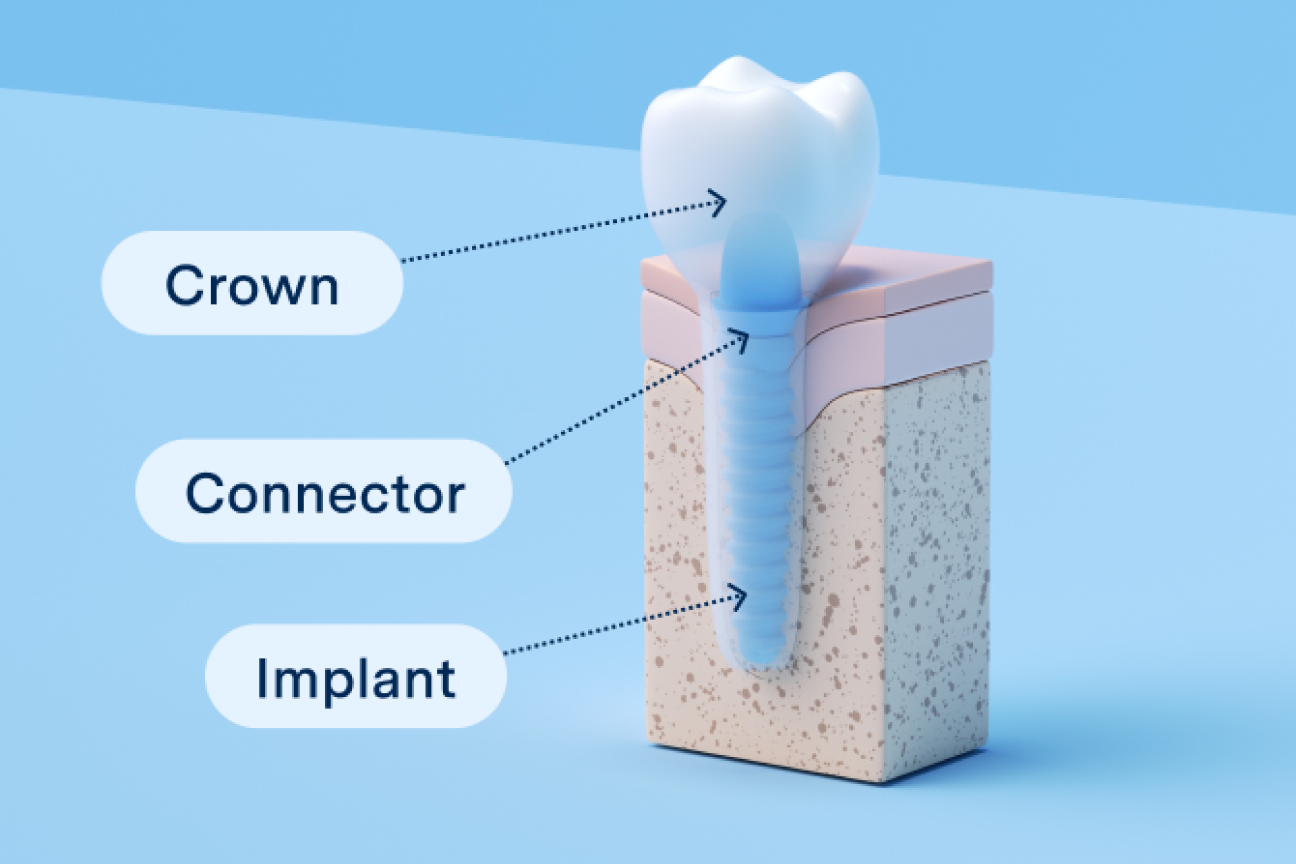 Diagram showing the structure of a front tooth dental implant with labeled parts including the crown, connector, and implant base, designed for Aspen Dental.